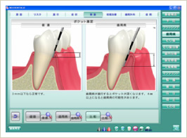 インプラント治療